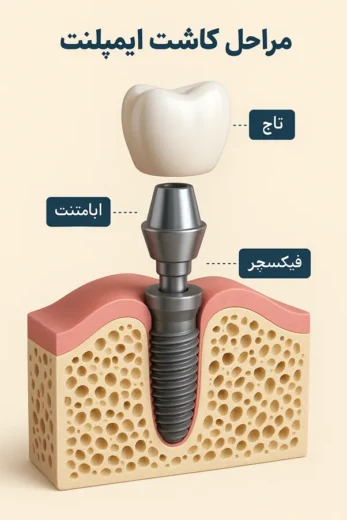 کاشت ایمپلنت دندان