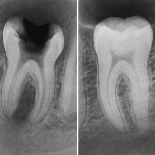نیاز به کشیدن دندان