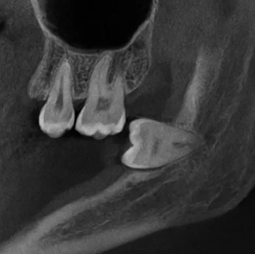 کشیدن دندان توسط دندانپزشک