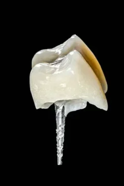 پست ریختگی دندان