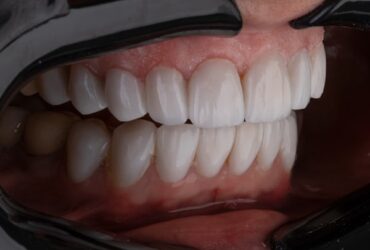 جراحی لیزری دندان عقل