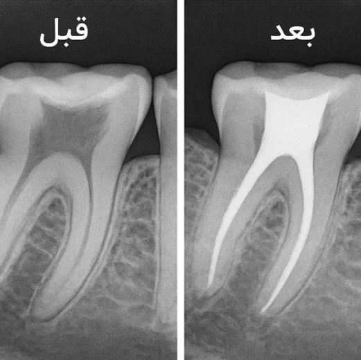 عصب‌کشی دندان