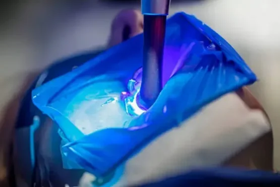 نحوه جراحی دندان عقل